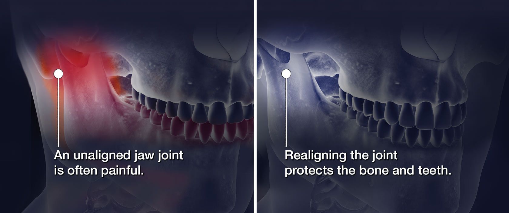 Illustration of x-ray of jaw before and after TMJ realignment