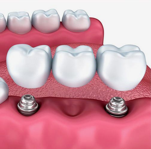 Implant bridge