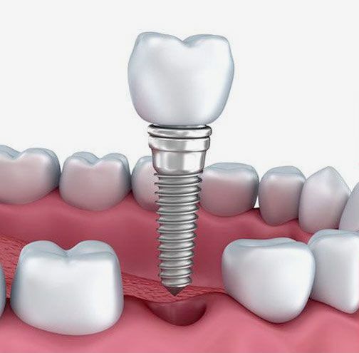 Implant crown